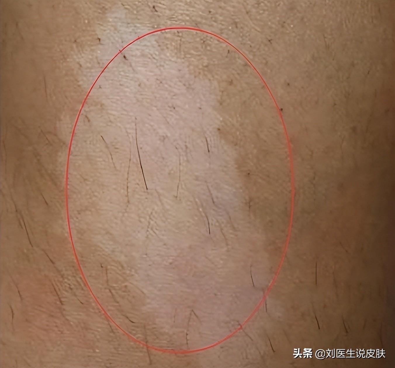 腋下胎记算命-为什么小时候打疫苗后