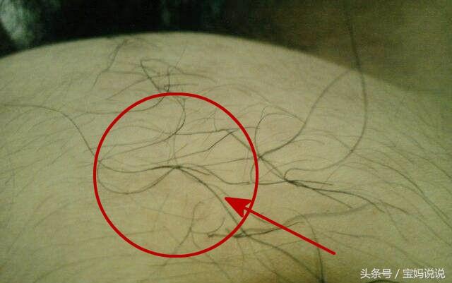女性肚脐下面长毛算命-体毛太多是什么原因